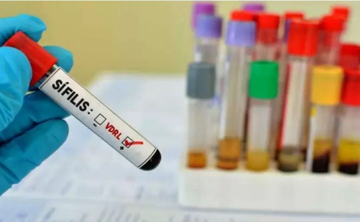 Aumentan los casos de sífilis en Mendoza y alertan por la falta de testeos en hombres